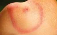 Uitbreidende rode ring of vlek op de huid na een tekenbeet (foto: RIVM)